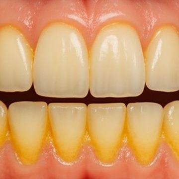 How to Remove Yellow Plaque on Teeth