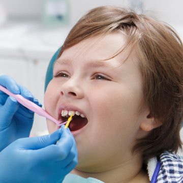 Fluoride Treatments