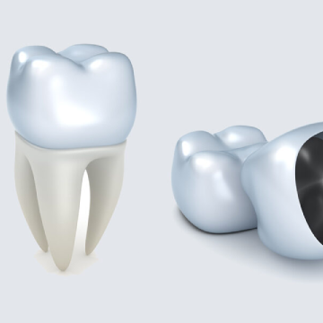 Dental-Bridges