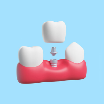 Dental Implants