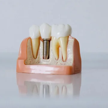 Dental Implant in Cedar Park, Dental Implant near you